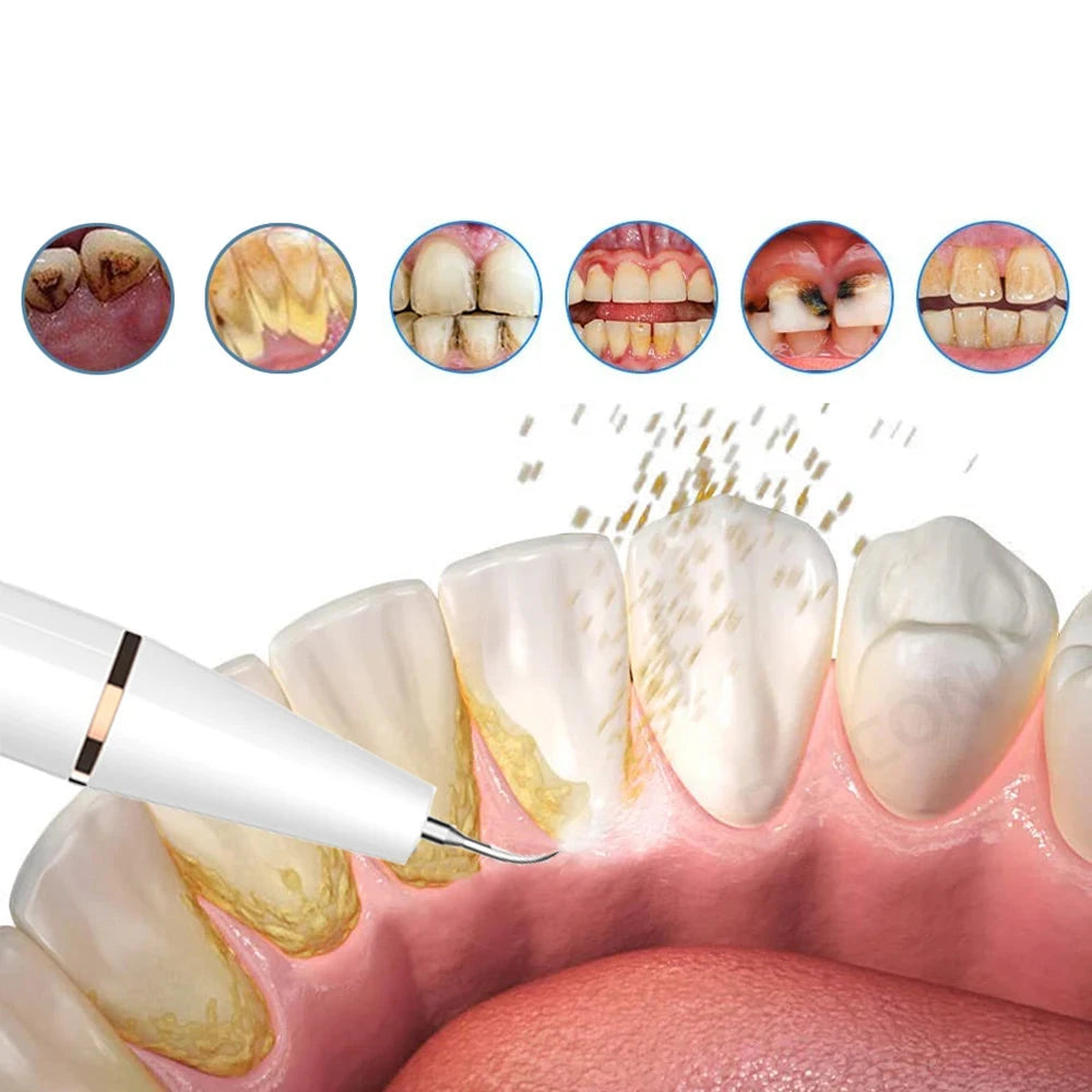 Ultrasone Plaque en Tartar Verwijderaar