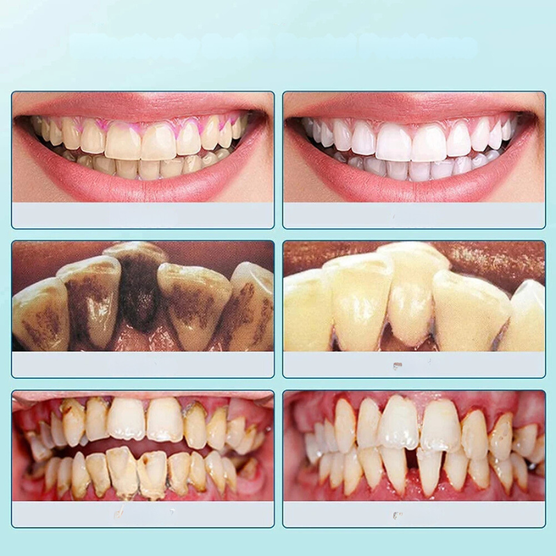 Ultrasone Plaque en Tartar Verwijderaar